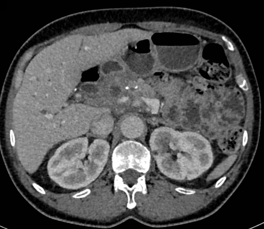 Chronic Pancreatitis with Narrowed Portal Vein - CTisus CT Scan