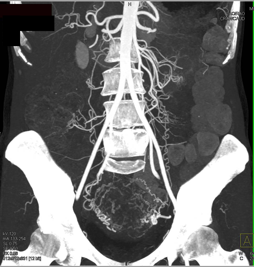 Vascular Map with Prominent Ovarian Arteries - CTisus CT Scan