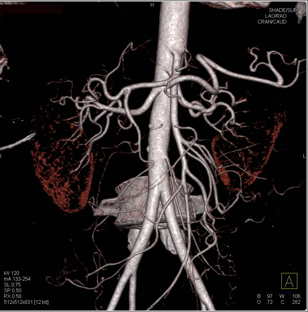 CTA 3D Map with Prominent Pelvic Arteries - CTisus CT Scan
