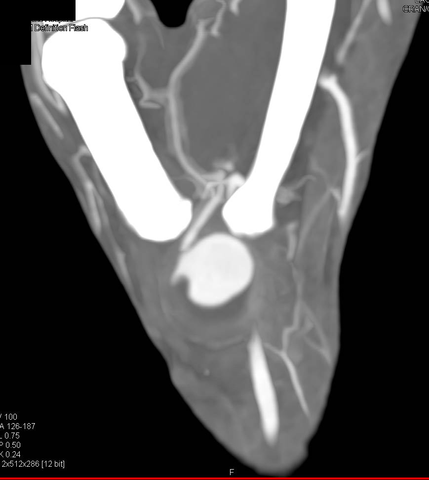 Arteriovenous Malformation (AVM) in Vascular Arcade of the Hand - CTisus CT Scan