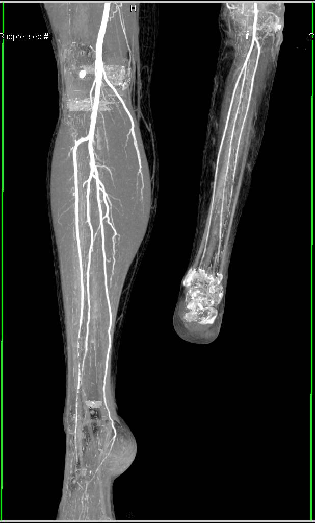 CTA Runoff in Patient with Reimplanted Lower Extremity - Vascular Case