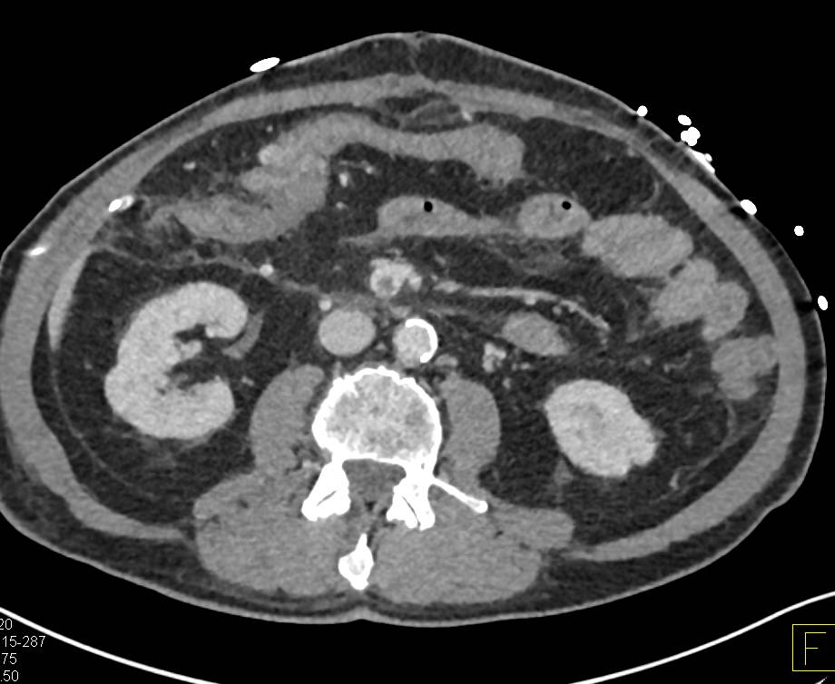 Occluded Superior Mesenteric Vein (SMV) Following Pancreatic Surgery ...