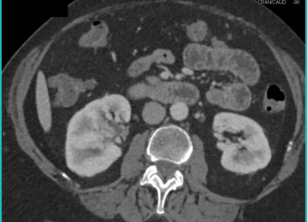 Renal Arteriovenous (AV) Fistulae in CTA and 3D - CTisus CT Scan