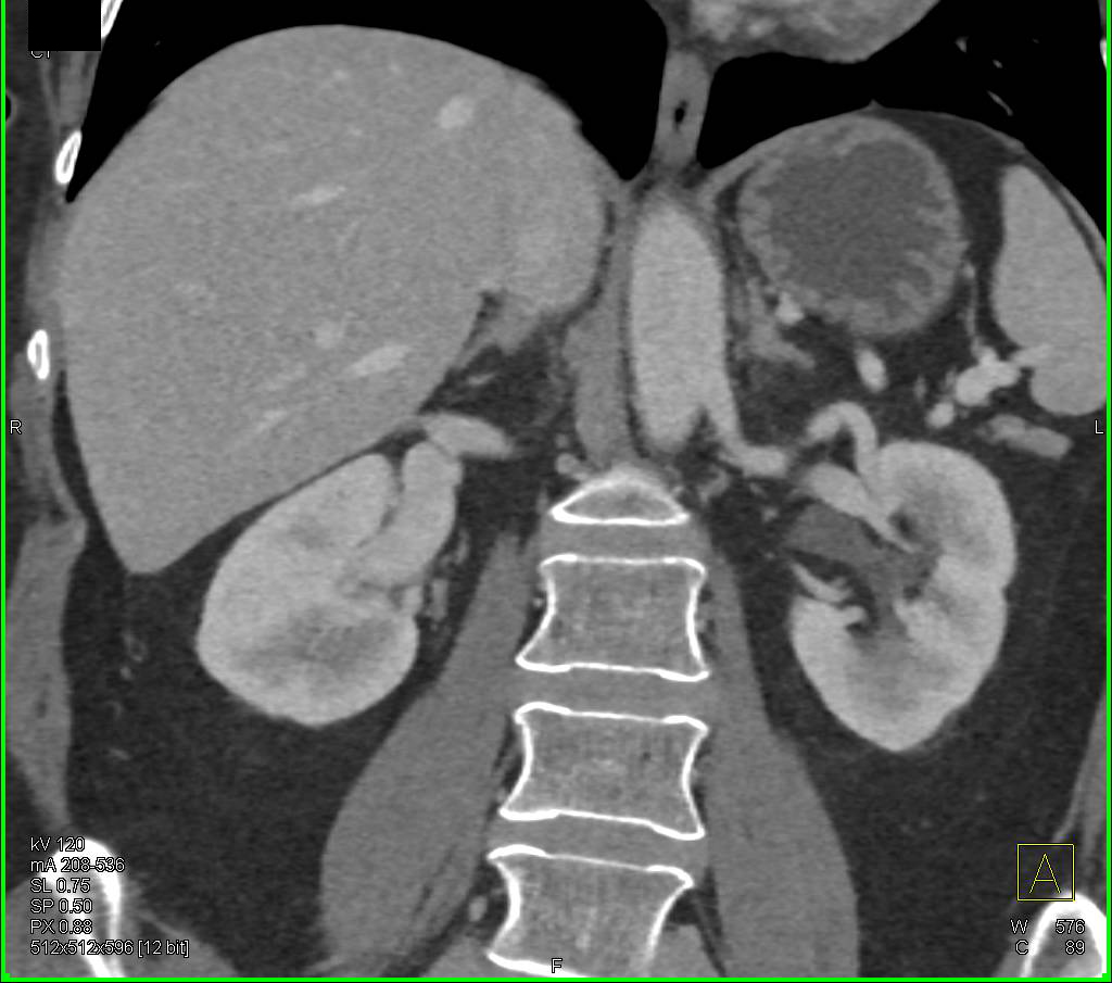 Renal Arteriovenous (AV) Fistulae in CTA and 3D - CTisus CT Scan