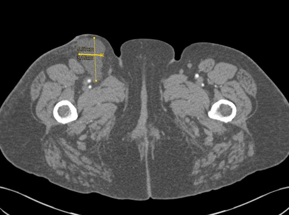 Seroma Right Thigh Following Stenting of Vessels. - CTisus CT Scan