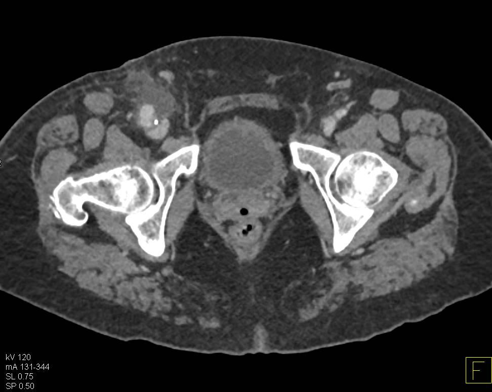 Pseudoaneurysm Right Groin - CTisus CT Scan