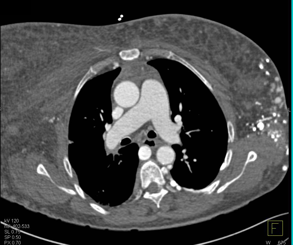 Extensive Vascular Collaterals Left Axilla and Intercostals due to Subclavian Vein Occlusion (Left) - CTisus CT Scan