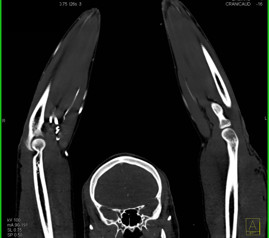 CTA Upper Extremities in Trauma Patient - CTisus CT Scan