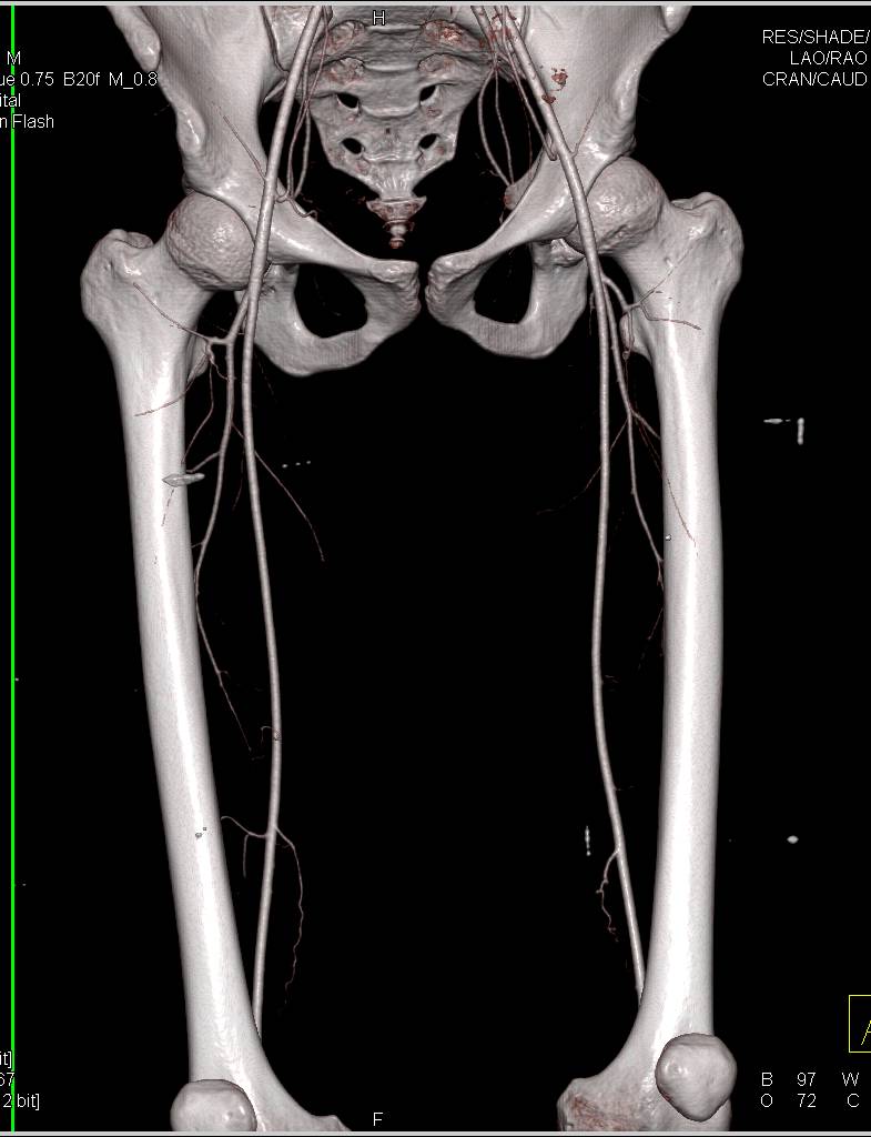 Normal CTA Dual Energy Runoff - CTisus CT Scan