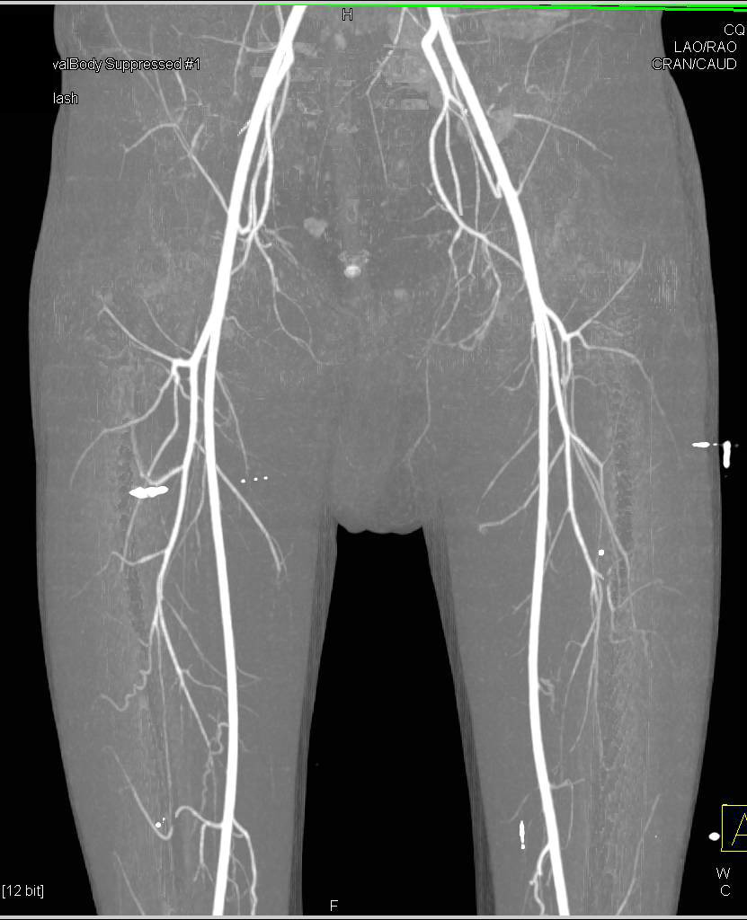 CTA Runoff with Flow Through Posterior Tibial Arteries - CTisus CT Scan