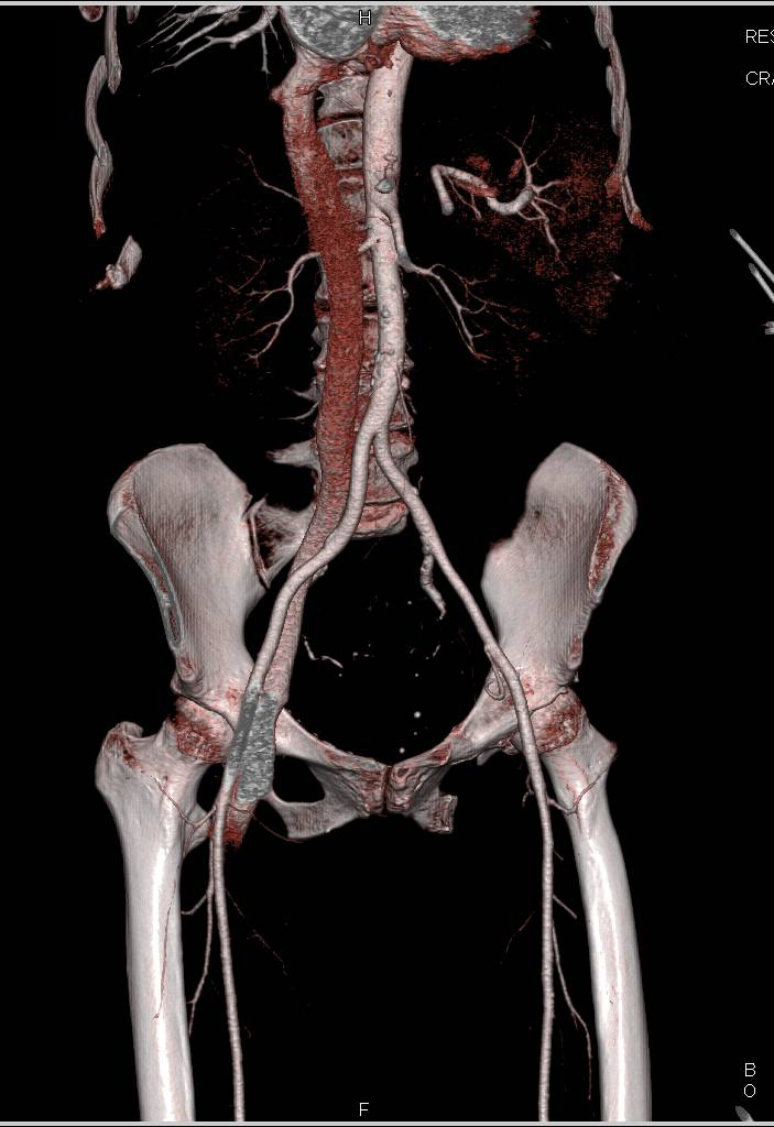 Thigh Hematoma s/p Vascular Procedure - CTisus CT Scan