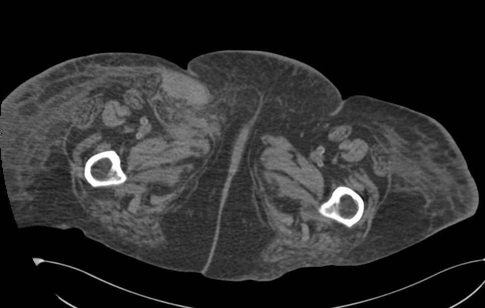 Early Venous Filling with Arteriovenous (AV) Shunt Following Invasive Procedure - CTisus CT Scan