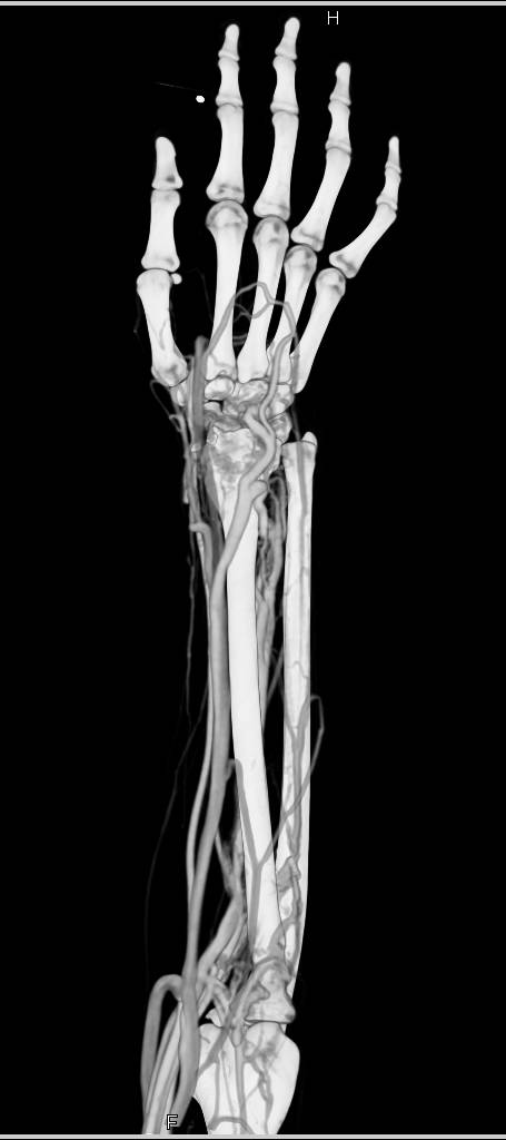 Arteriovenous (AV) Fistulae at the Wrist in 3D Display - CTisus CT Scan