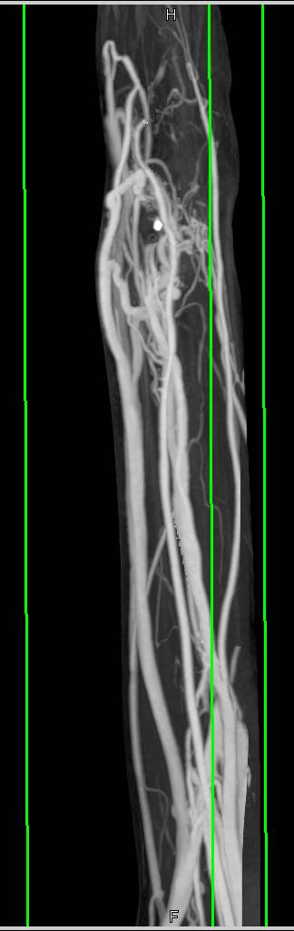 Arteriovenous (AV) Fistulae at the Wrist in 3D Display - CTisus CT Scan