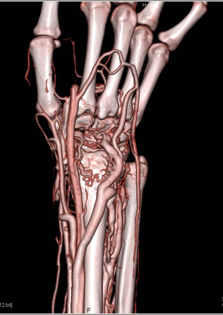 Arteriovenous (AV) Fistulae at the Wrist in 3D Display - CTisus CT Scan