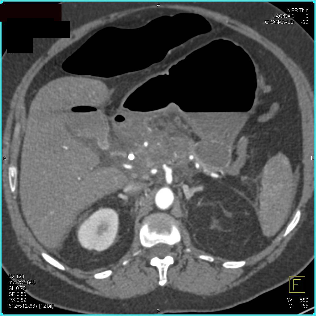 Pancreatic Adenocarcinoma Encases the Arterial and Venous Structures with Portal Vein Thrombosis (PVT) - CTisus CT Scan