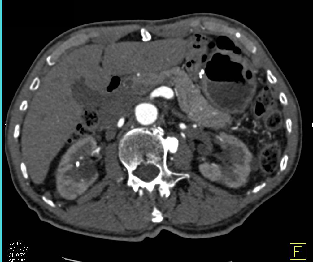 Stenosis Origin Superior Mesenteric Artery (SMA) Which is Dilated with Collaterals - CTisus CT Scan