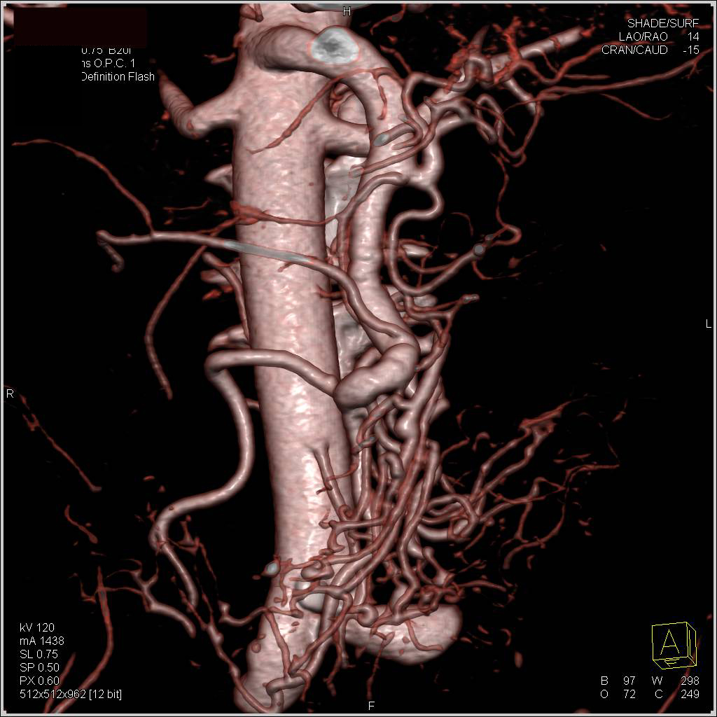 Stenosis Origin Superior Mesenteric Artery (SMA) Which is Dilated with Collaterals - CTisus CT Scan