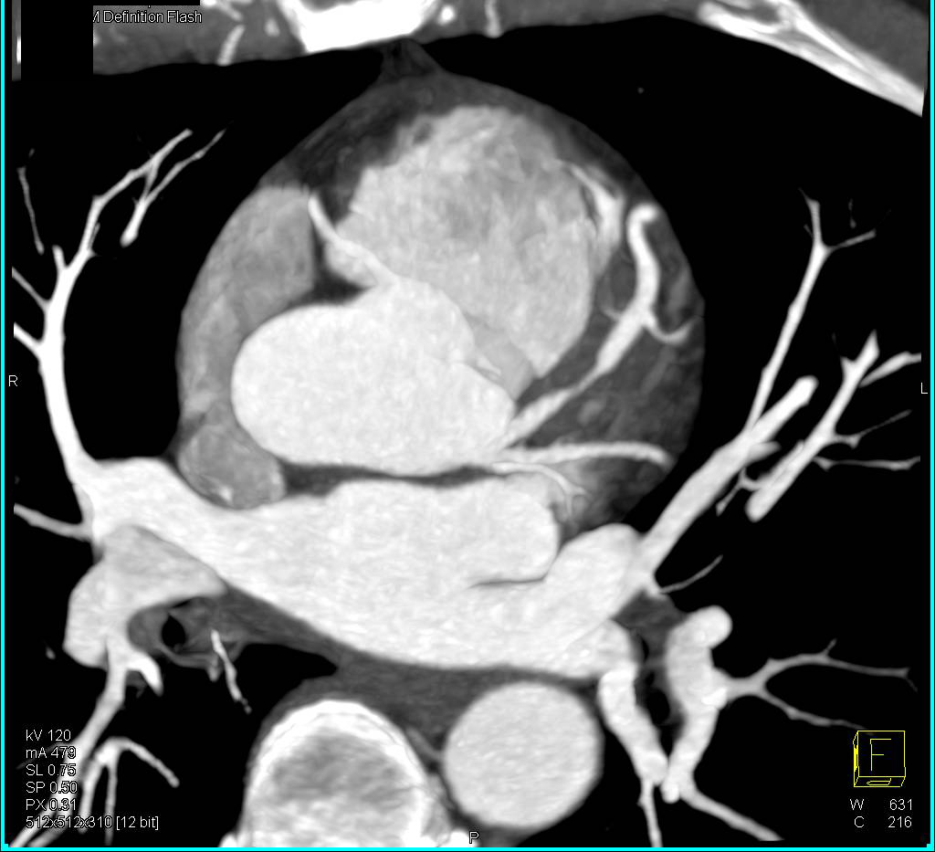 CCTA: High Grade Left Anterior Descending Coronary Artery (LAD) Stenosis in 3D with VRT - CTisus CT Scan