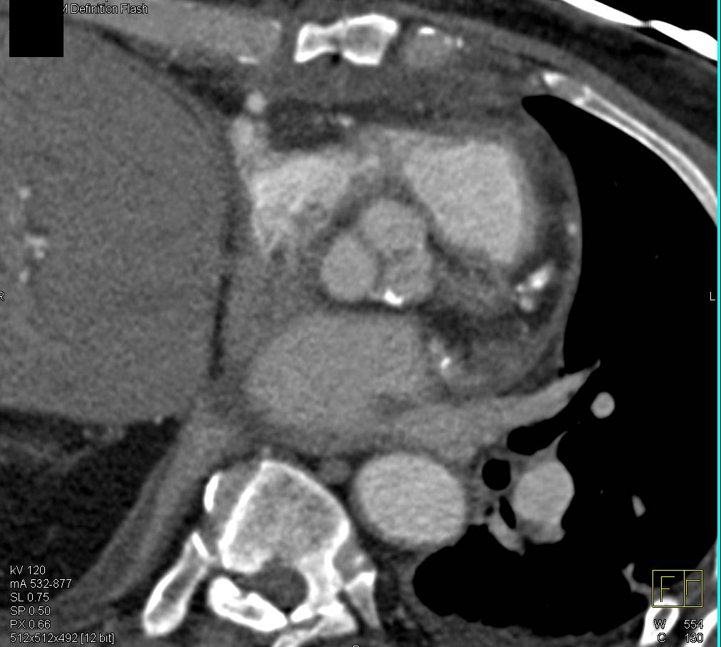 Type A Dissection Nicely Seen with Gated Acquisition - CTisus CT Scan