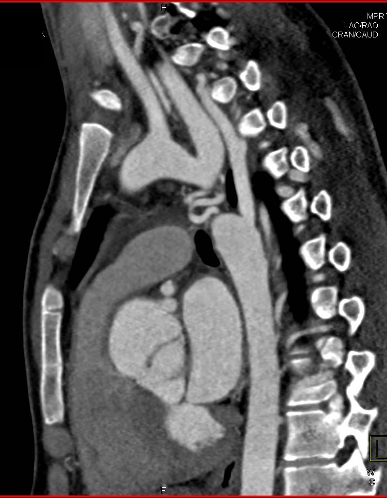 Occlusion of Aortic due to Severe Coarctation of the Aorta - CTisus CT Scan