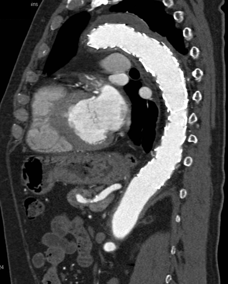 Endovascular Stent in Descending Thoracic Aorta as well as Superior Mesenteric Artery (SMA) Dissection - CTisus CT Scan