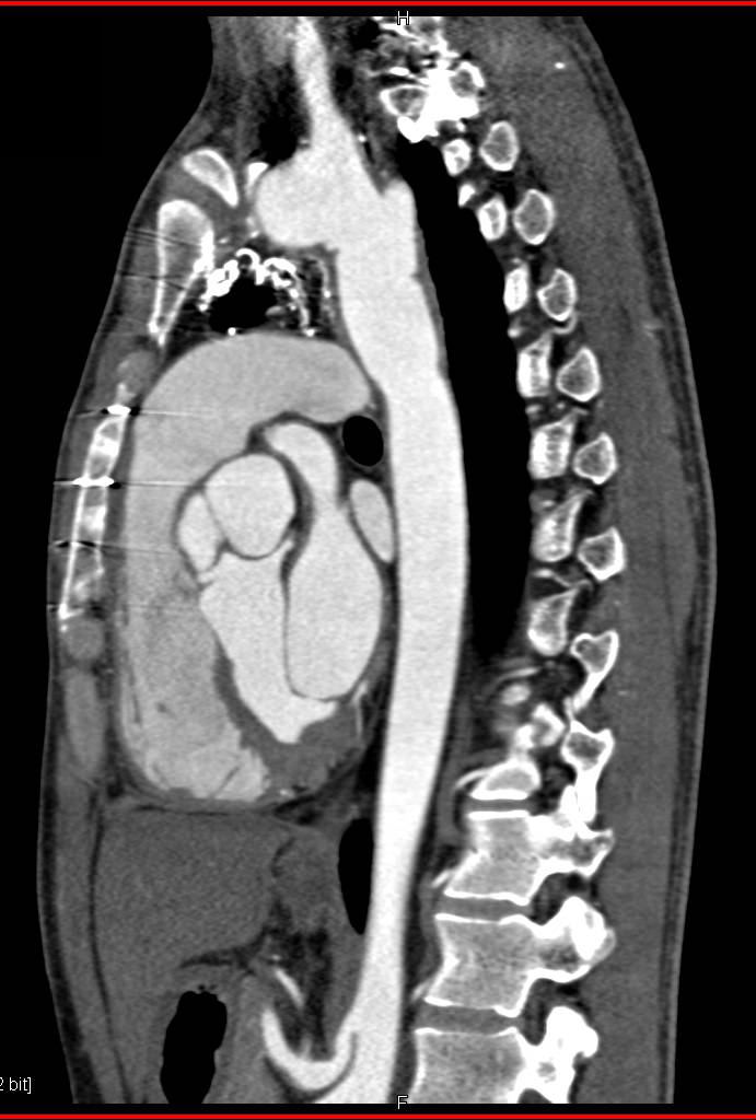 Coarctation of the Aorta Repaired with Graft - CTisus CT Scan