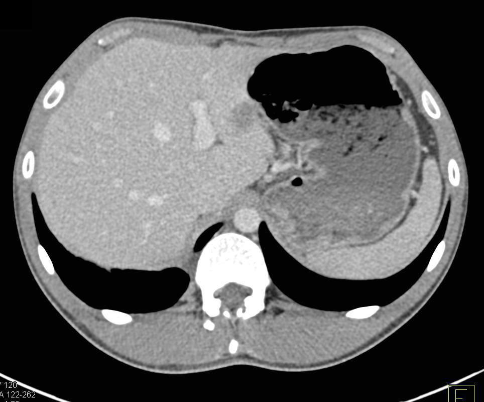 Carcinomatosis with Inferior Vena Cava (IVC) Clot - CTisus CT Scan