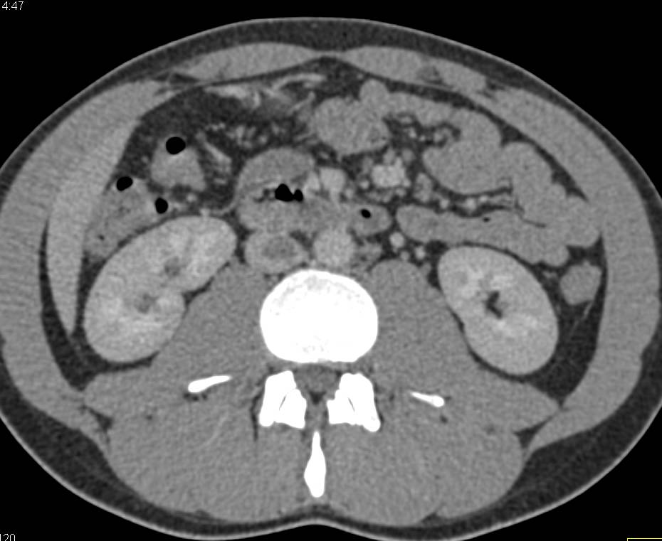 Lymphoma with Inferior Vena Cava (IVC) Clot - CTisus CT Scan