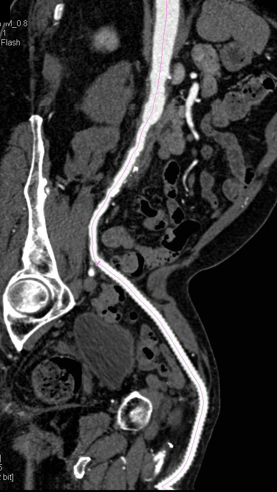 Vessel Tracking of a Fem-Fem Bypass Patency - CTisus CT Scan