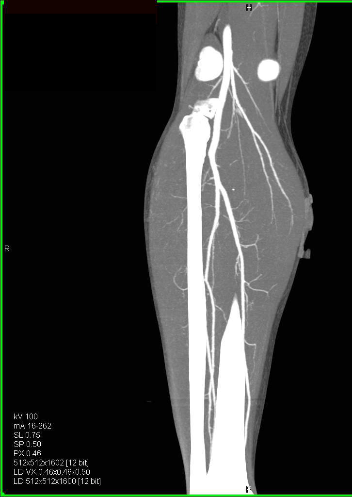 CTA Runoff Study as Potential Harvest Arterial Study - CTisus CT Scan