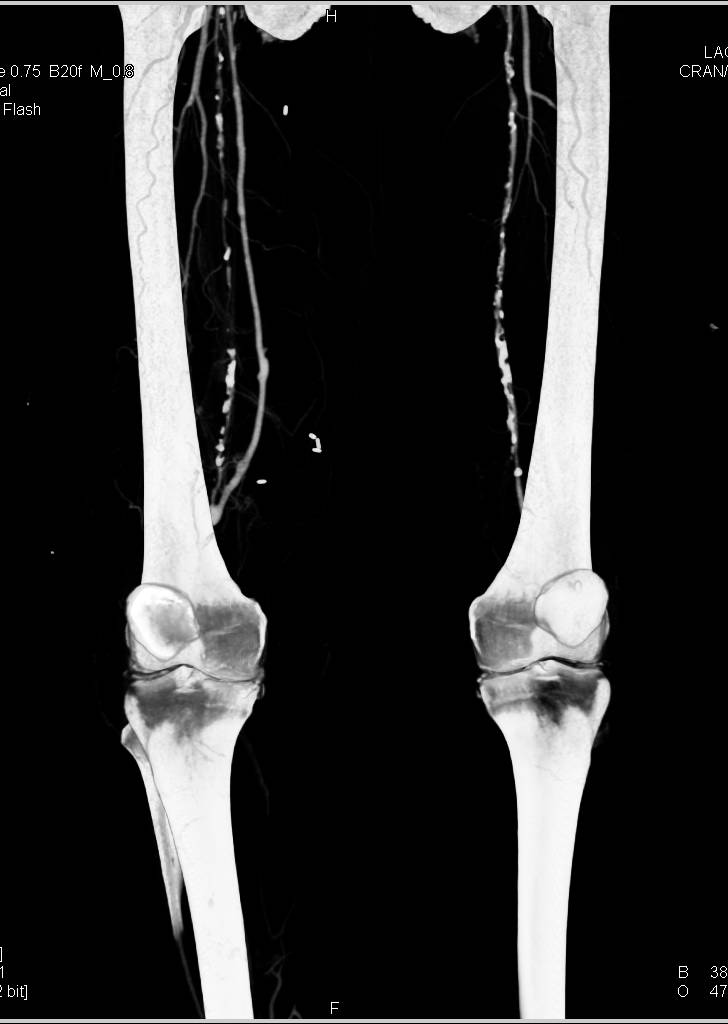 Dual Energy with Bone Removal for Runoff with Peripheral Vascular Disease (PVD) - CTisus CT Scan