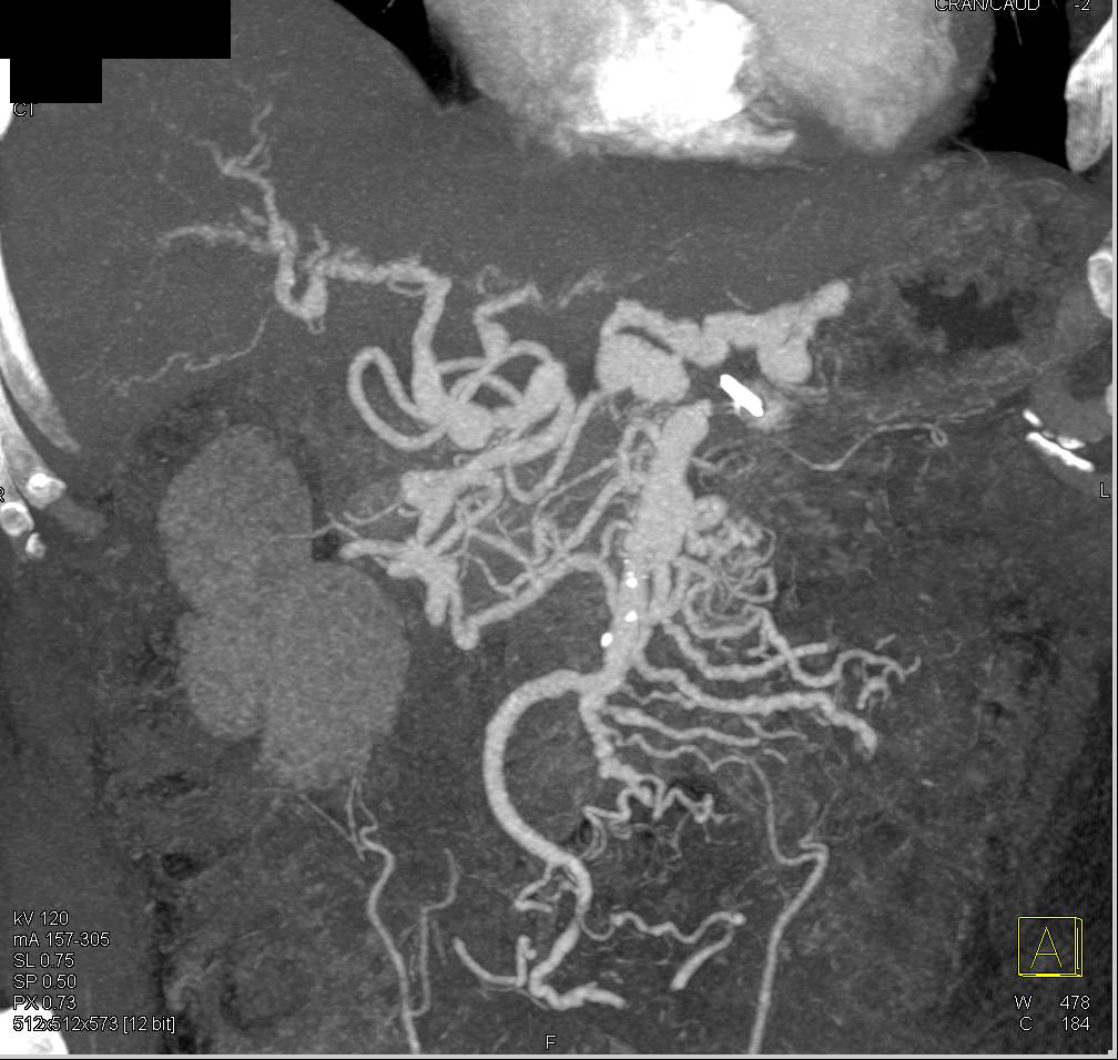 Vasculitis with Multiple Aneurysms of Superior Mesenteric Artery (SMA) and Celiac Arteries - CTisus CT Scan