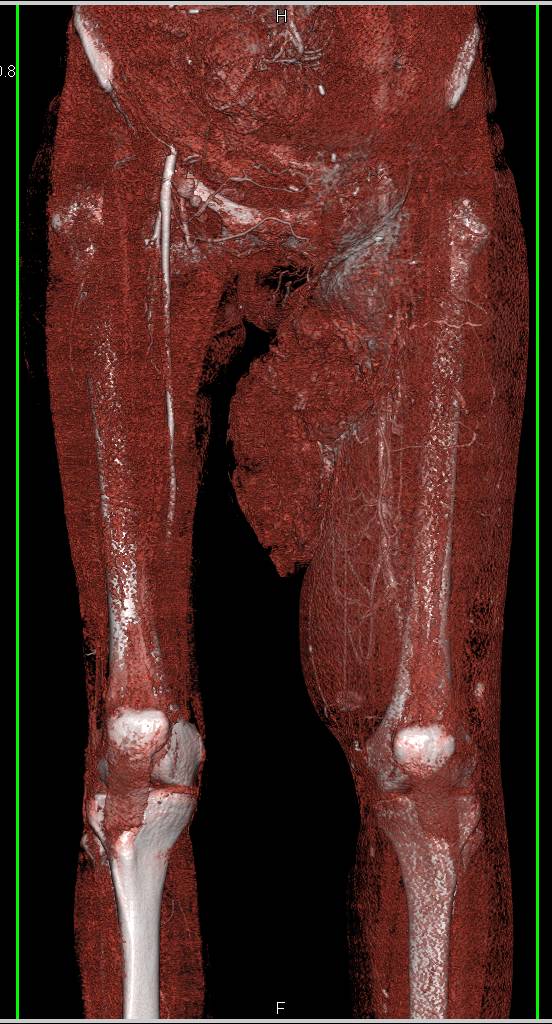 Ulcerating Sarcoma Right Inner Thigh - CTisus CT Scan