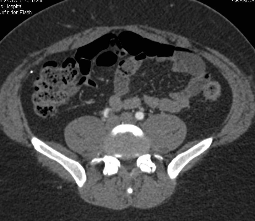 Atheromatous Plaque in Right Common Iliac Artery - CTisus CT Scan