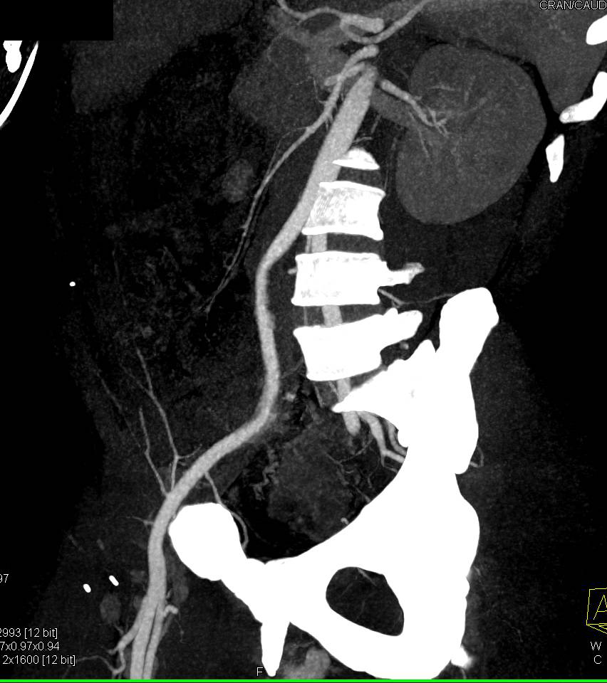 CTA Evaluation of Stent Which is Patent - CTisus CT Scan