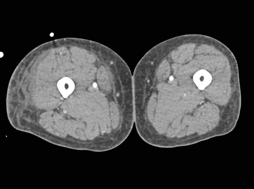 CTA Runoff with Patent Vessels and Cellulitis - CTisus CT Scan