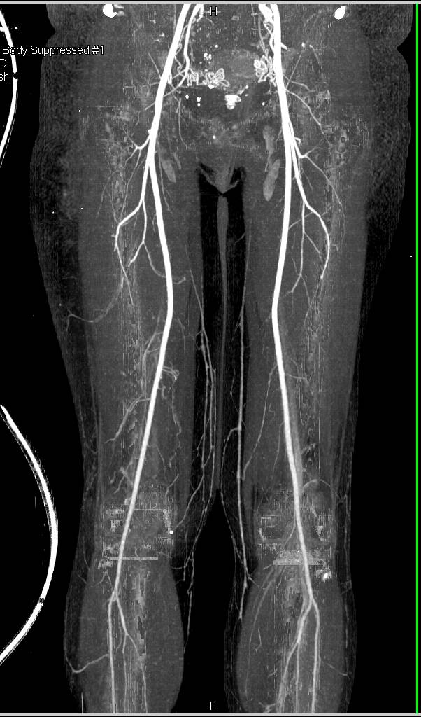 CTA Runoff with Single and Dual Energy CT - CTisus CT Scan