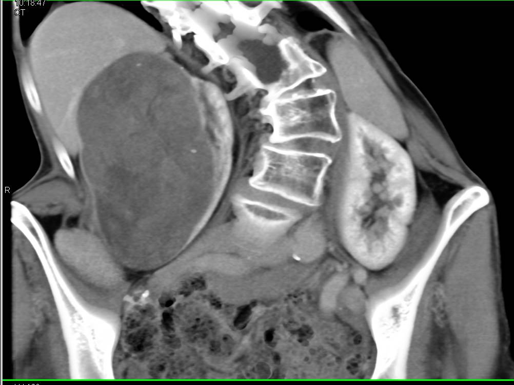 Incidental Renal Cell Carcinoma in Patient for Evaluation of an Aortic Dissection - CTisus CT Scan