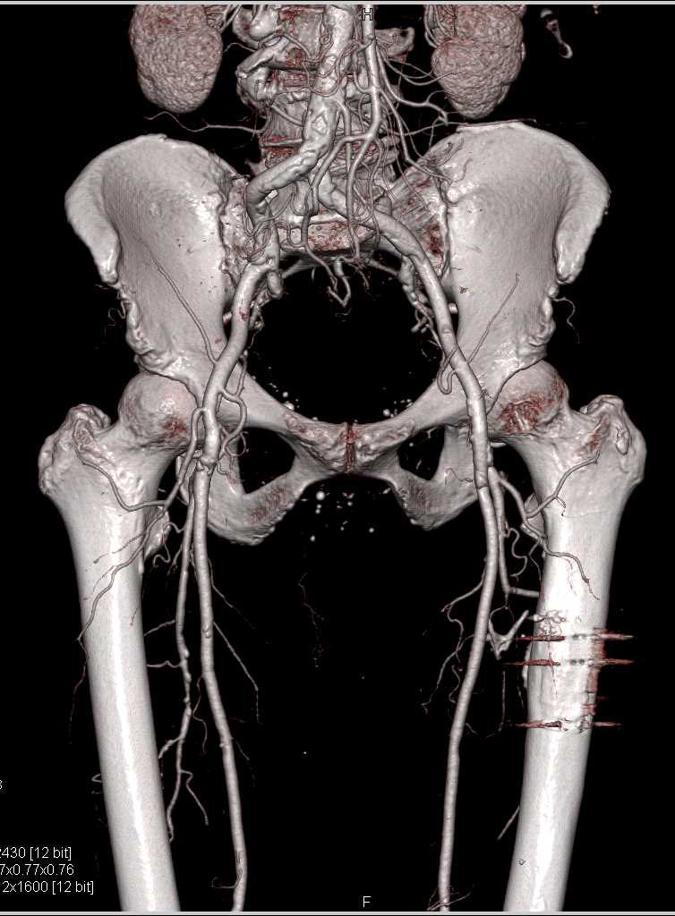 CTA Runoff with Single and Dual Energy CT with Peripheral Vascular Disease (PVD) - CTisus CT Scan