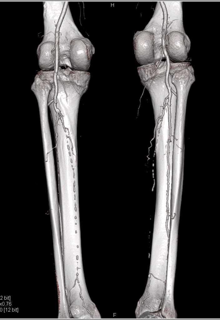 CTA Runoff with Single and Dual Energy CT with Peripheral Vascular Disease (PVD) - CTisus CT Scan