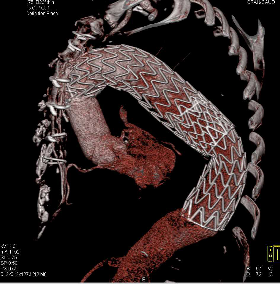 Thoracic Aorta Endovascular Stent with Endoleak - CTisus CT Scan