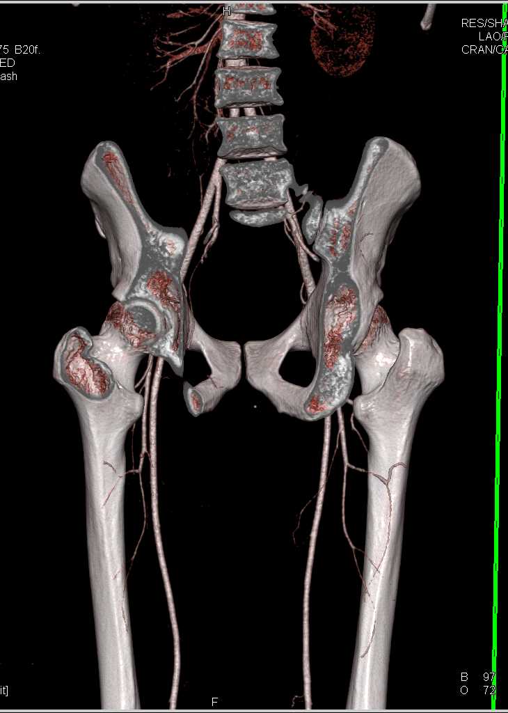 Runoff with Occluded Left Popliteal Artery - CTisus CT Scan