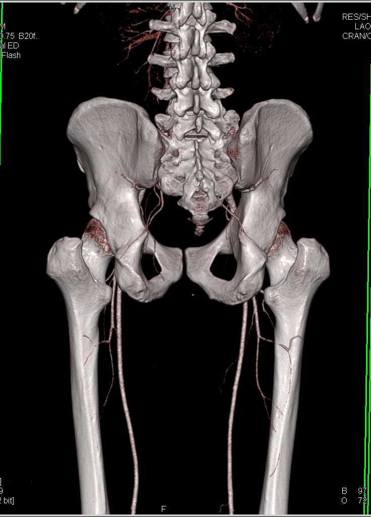 Left Popliteal Artery Occlusion Following Trauma with Dual Energy - CTisus CT Scan