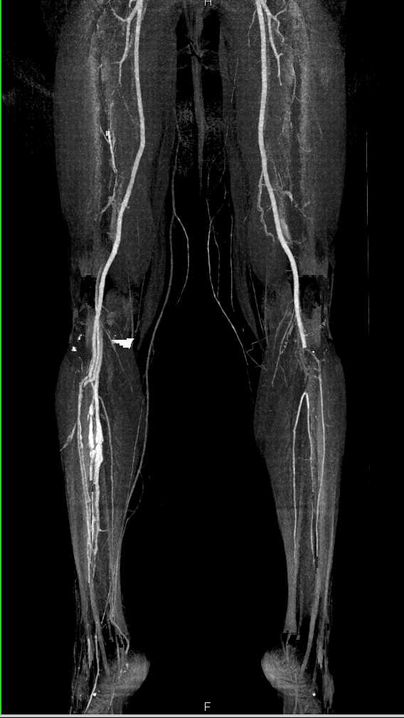 CT Runoff with Occlusion of Left Popliteal Artery due to Thrombus - CTisus CT Scan