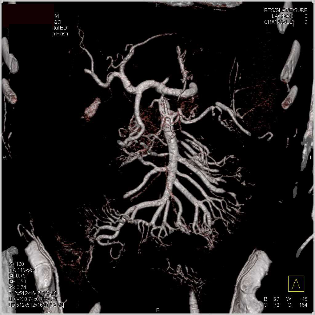 End Stage Renal Disease with Extensive Vascular Disease in Abdomen - CTisus CT Scan