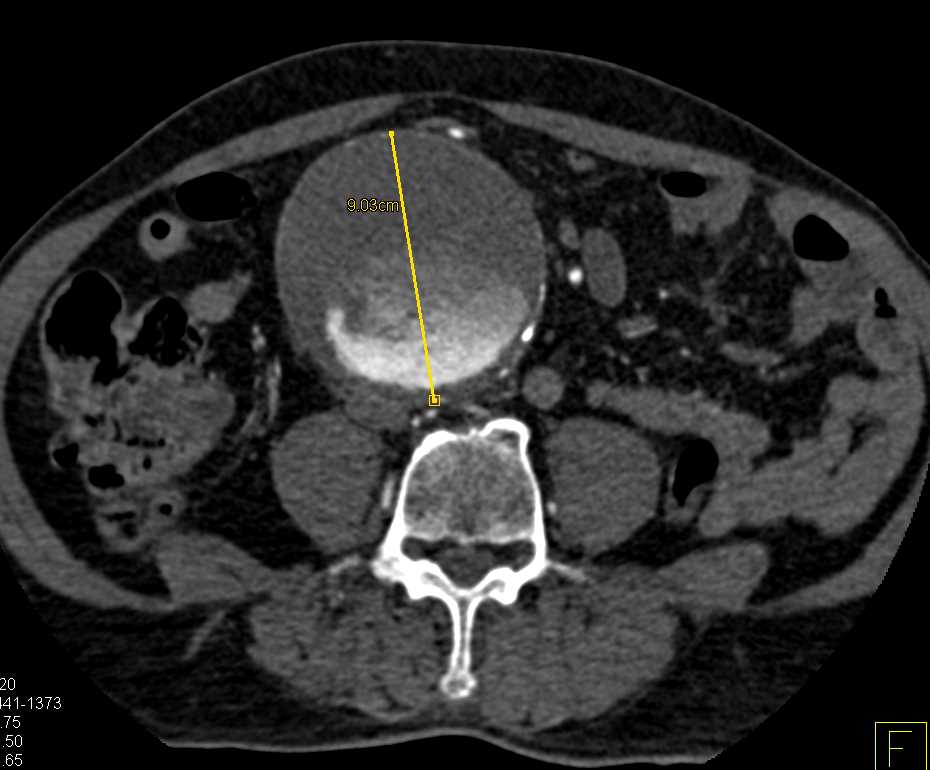 Enlarging Abdominal Aortic Aneurysm with Pending Rupture in Patient with Paget's Disease - CTisus CT Scan