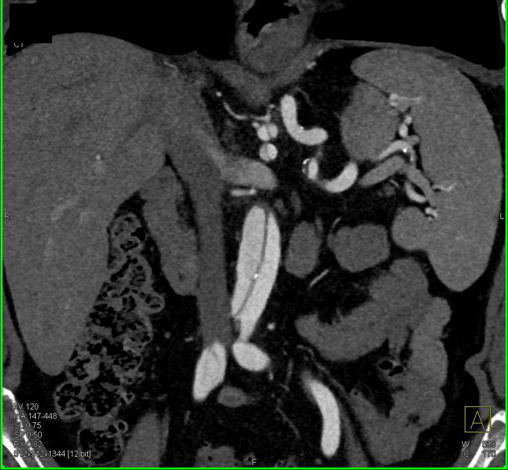 Aortic Dissection Involves Both the Superior Mesenteric Artery (SMA) and Celiac Artery - CTisus CT Scan