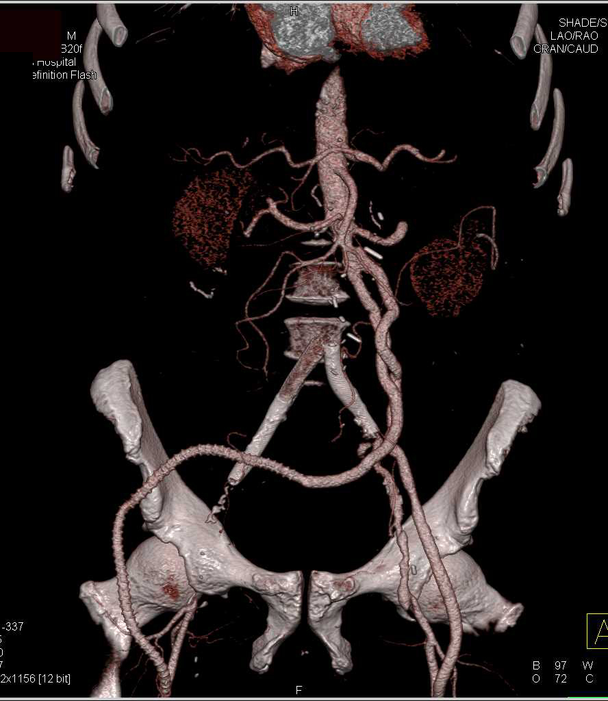 CTA with Bypass Grafts from Aorta to Superficial Femoral Arteries (SFAs) Bilaterally - CTisus CT Scan