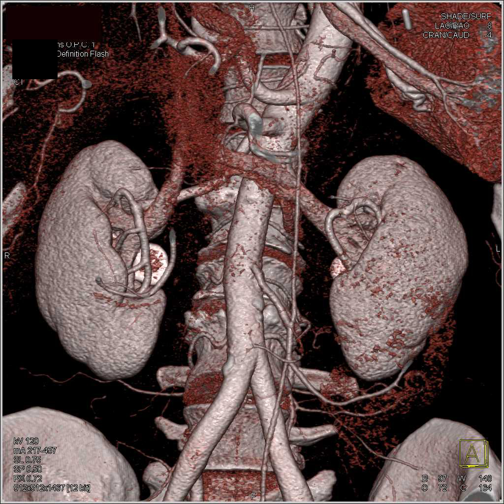 Aortic Repair with Vascular Reconstruction and Mapping - CTisus CT Scan